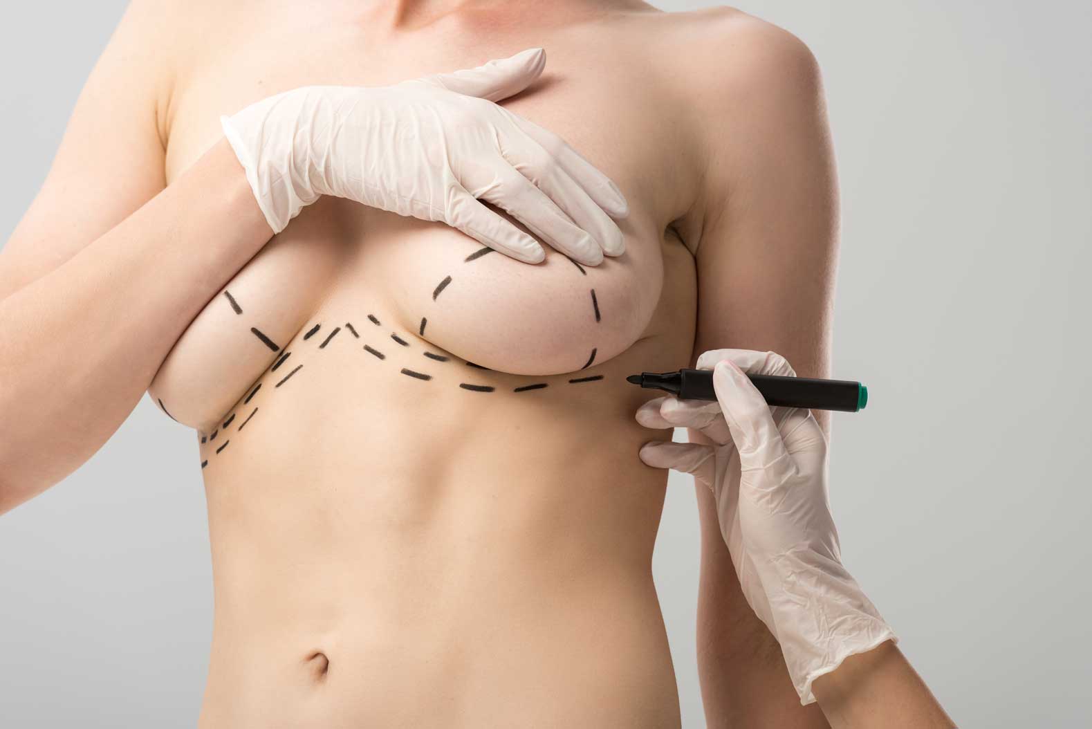 Breast Lifting