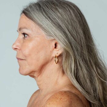 Neck Lift Extended