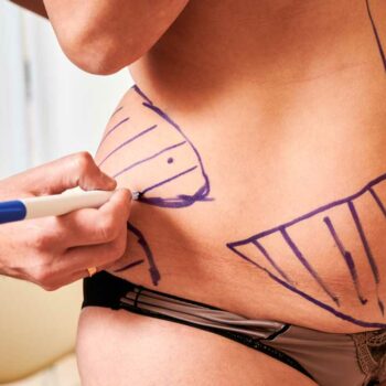 Tummy Tuck Extended