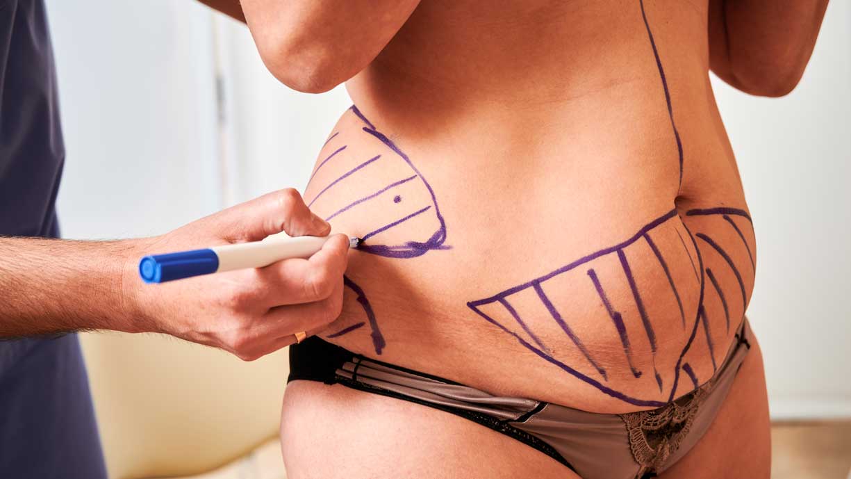 Tummy Tuck Extended