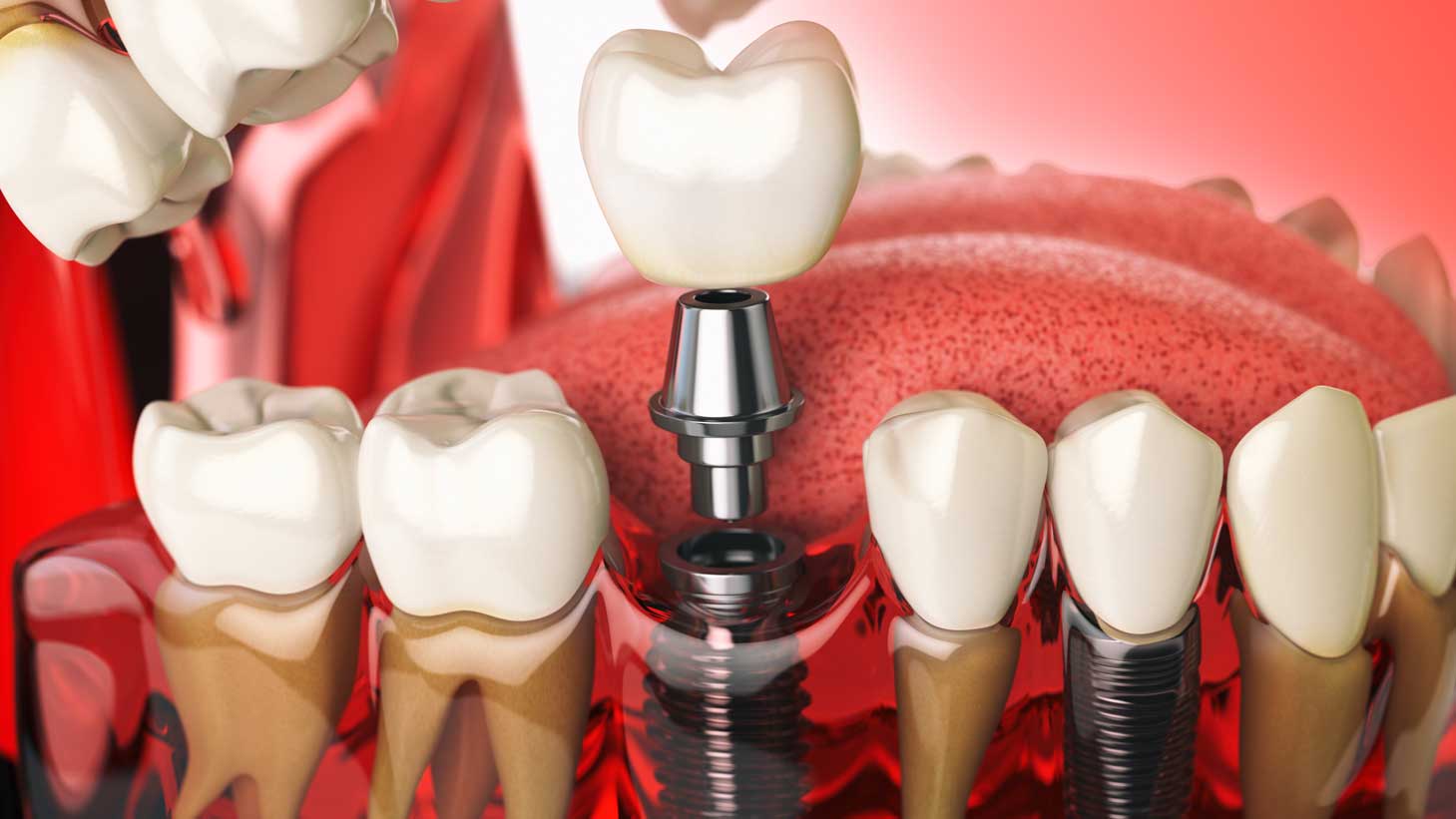 Implant Dentistry